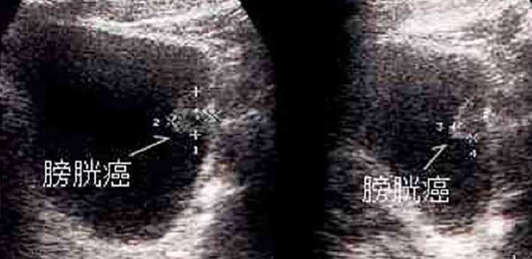 膀胱がんの腹部超音波検査画像