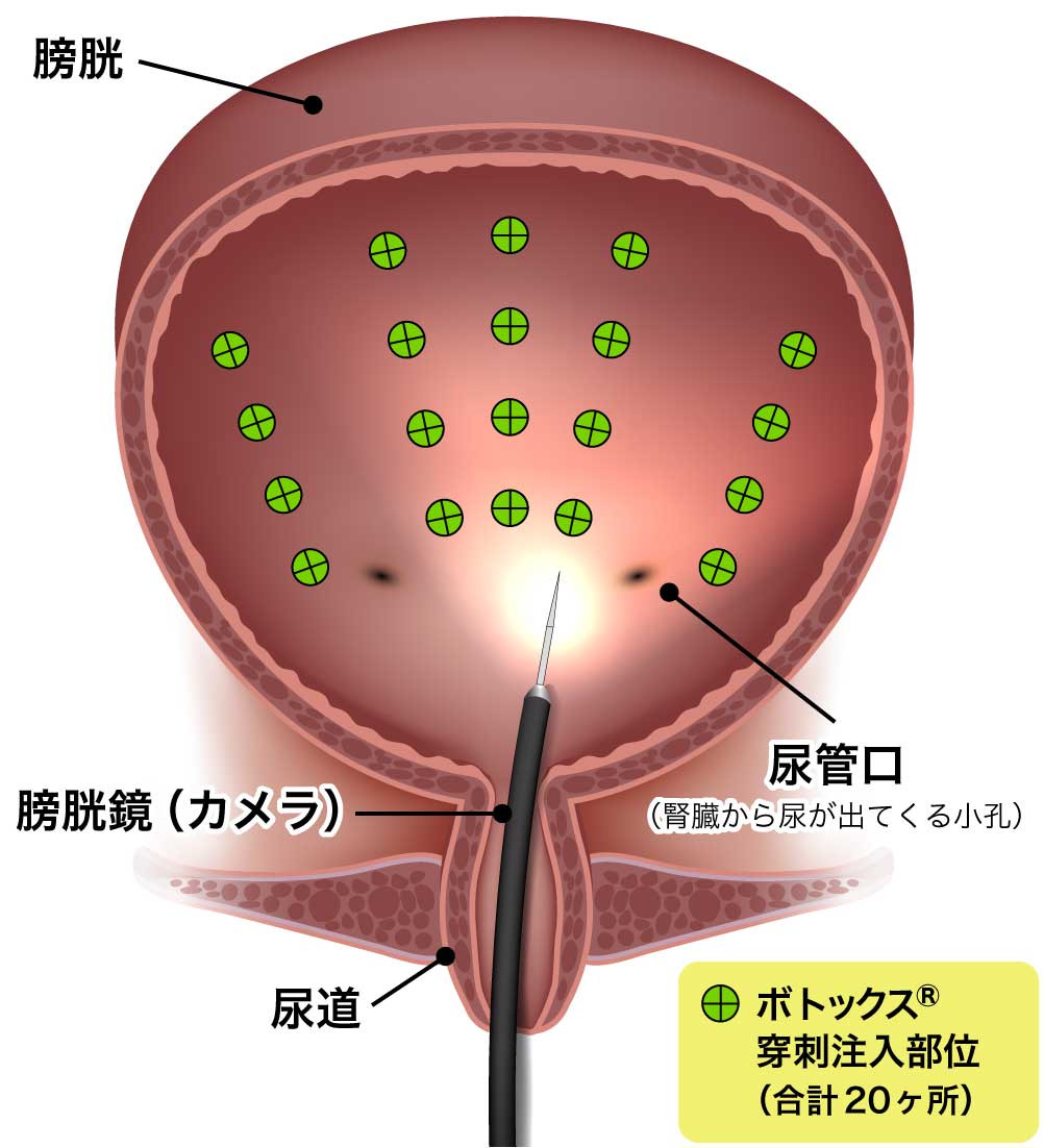 ボツリヌス毒素膀胱壁内注入療法図解