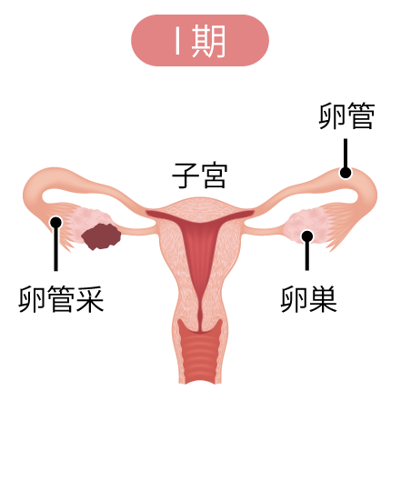 卵巣腫瘍（卵巣がん）の病期Ⅰ期