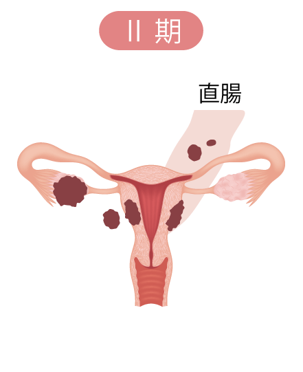 卵巣腫瘍（卵巣がん）の病期II期