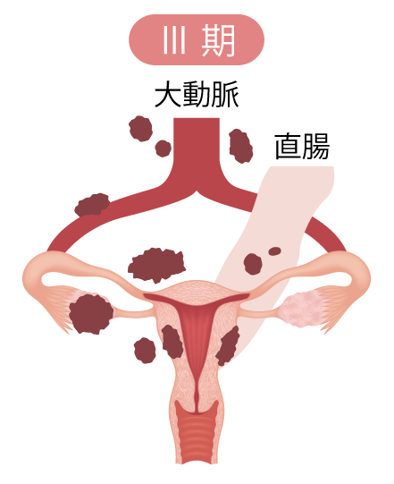 卵巣腫瘍（卵巣がん）の病期Ⅲ期