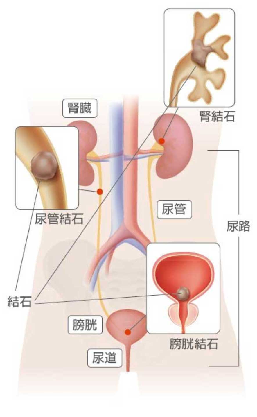 腎・尿管結石 泌尿器科の疾患 東京八重洲クリニック